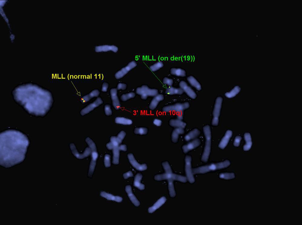 Figure 9. FISH on second bone marrow:  involved side.  This metaphase FISH shows the complex rearrangement of MLL.